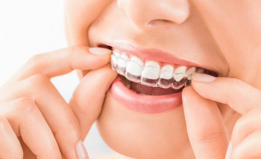Invisalign: Exploring the Intersection of Clear Aligners and Digital Wellness