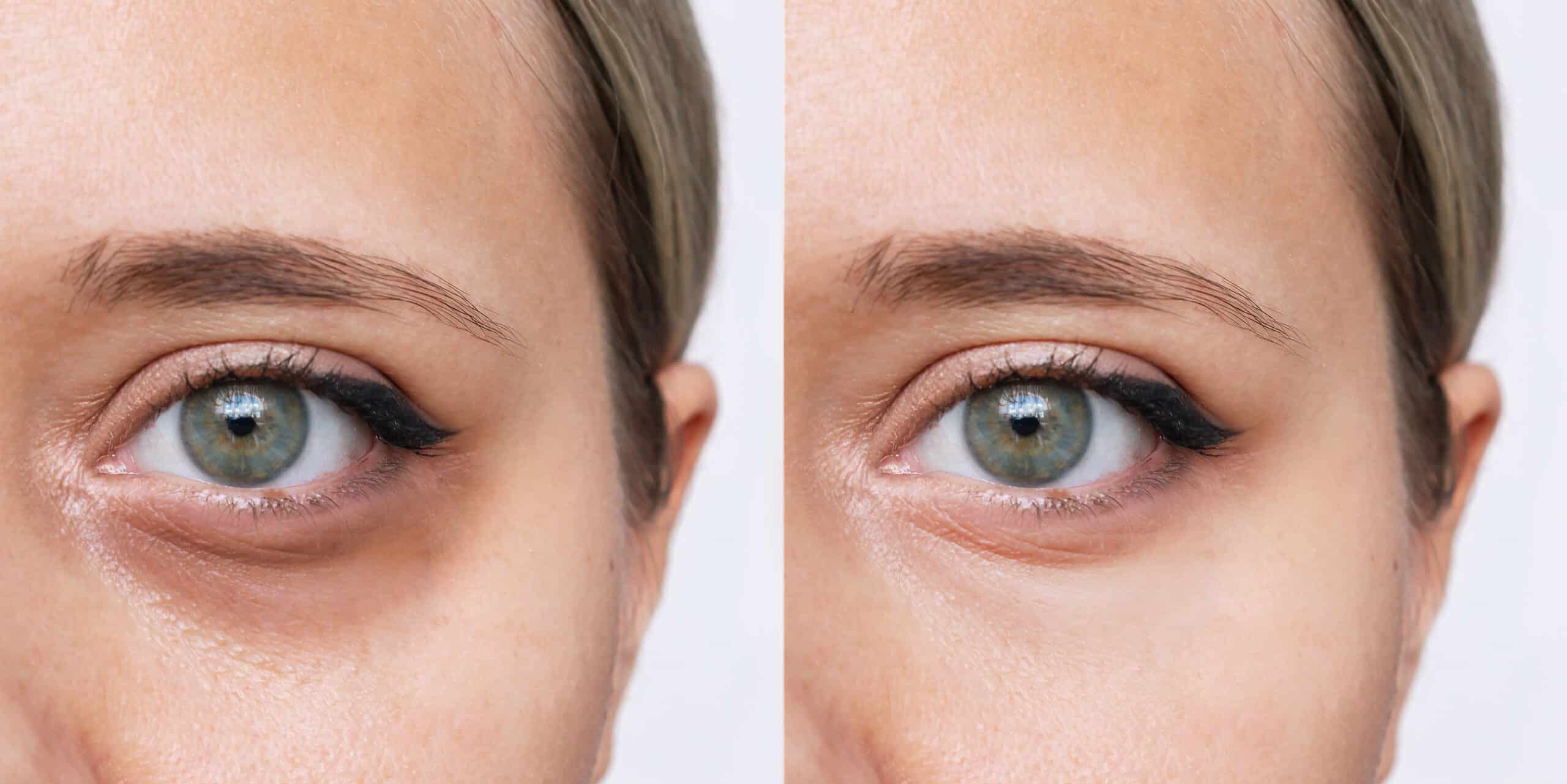 Subtle cosmetic changes that create brighter youthful eye appearance